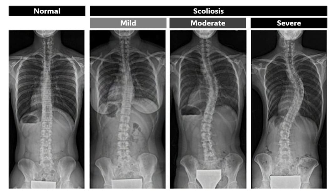 X-ray image of the spine and scoliosis